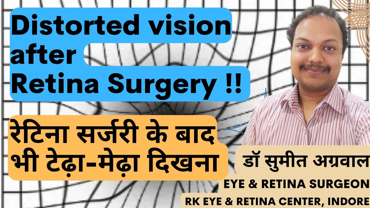 Succesfull रेटिना surgery के बाद भी नज़र का टेढ़ा-मेढ़ा होना ! Distorted vision after Retina Surgery !!