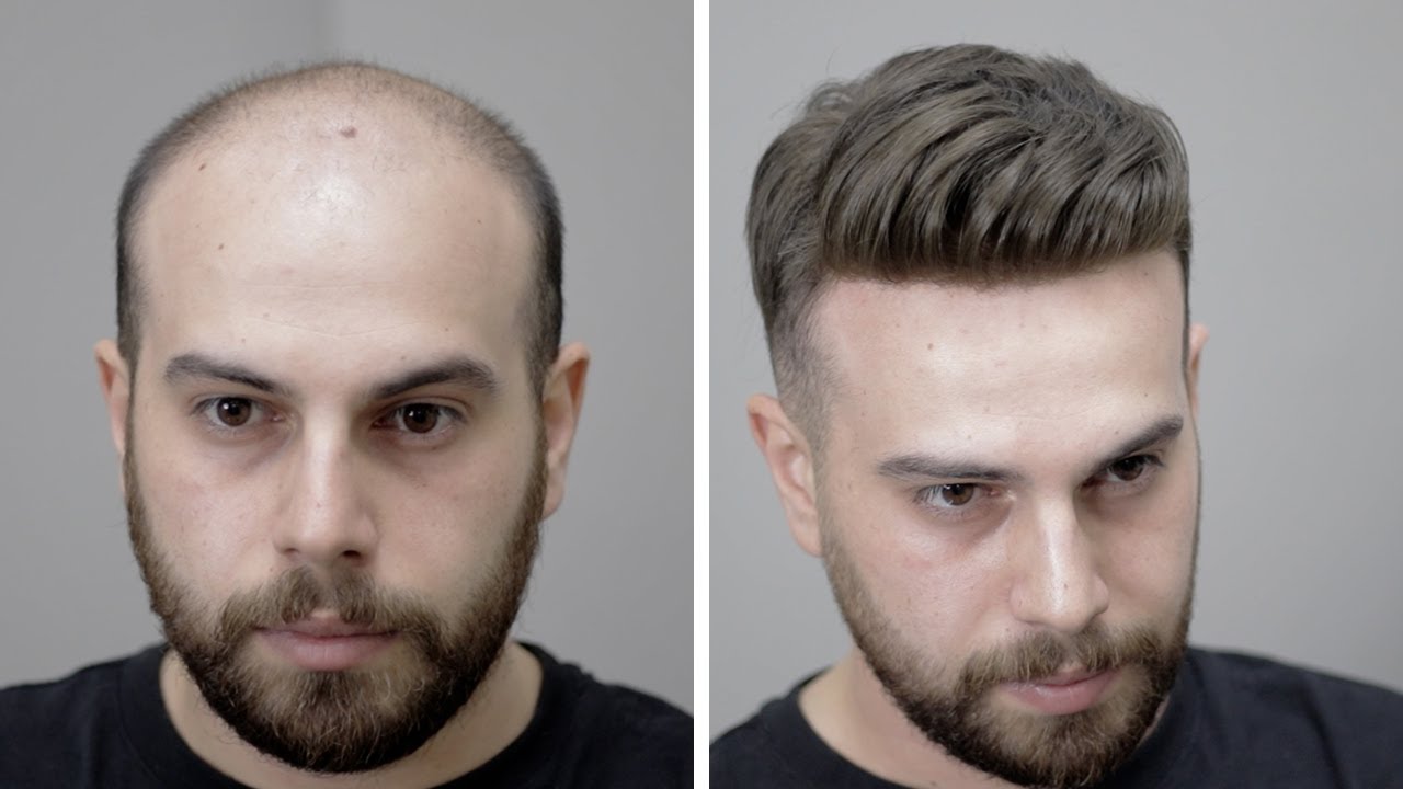 PROTEZ SAÇ İLE KENDİNİ YENİDEN KEŞFET! - Hair Replacement