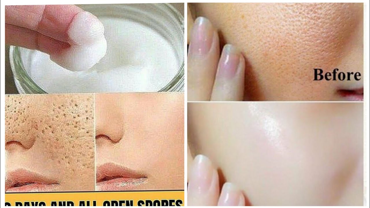 Doldolelka iyo dhigrorka Wajiga😱remove pores on face