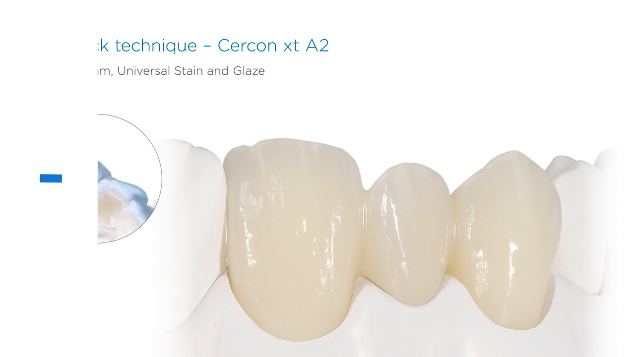 Allceramic Cercon xt Cutback Celtra Ceram