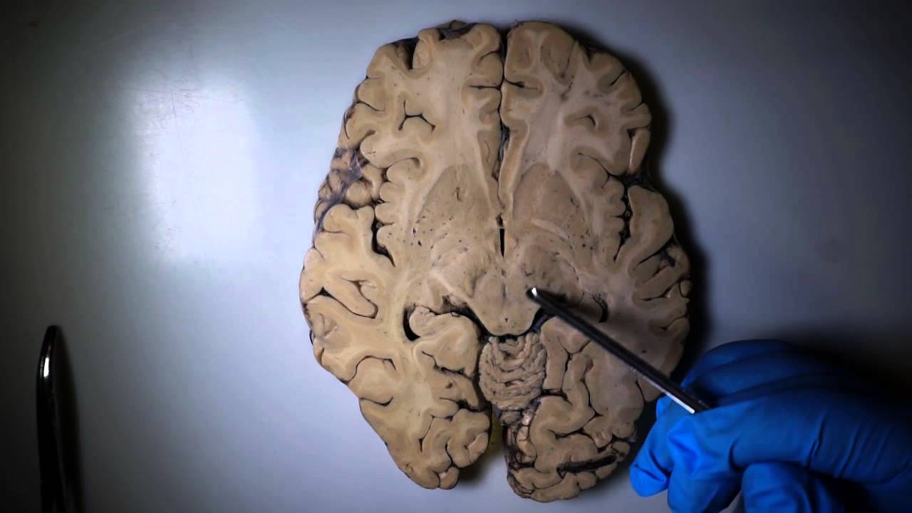 Morfología interna cerebro