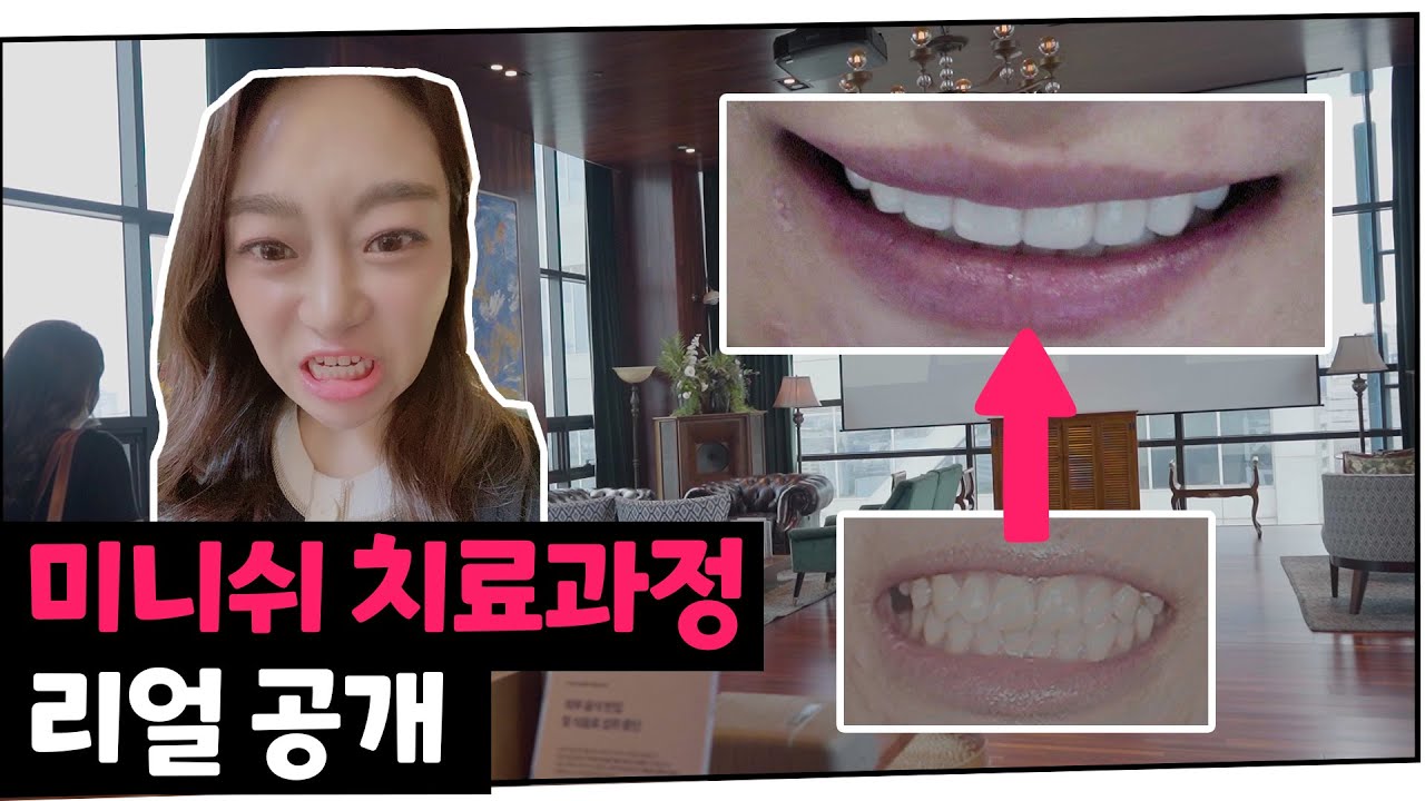 미니쉬 치료과정 리얼 공개, 단 하루만에 치아가 예뻐지는 과정