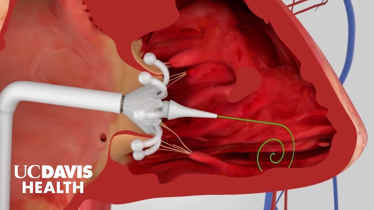 Minimally Invasive Procedures for Structural Heart Disease