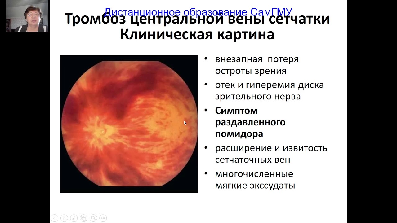 Патология глазного дна часть 2