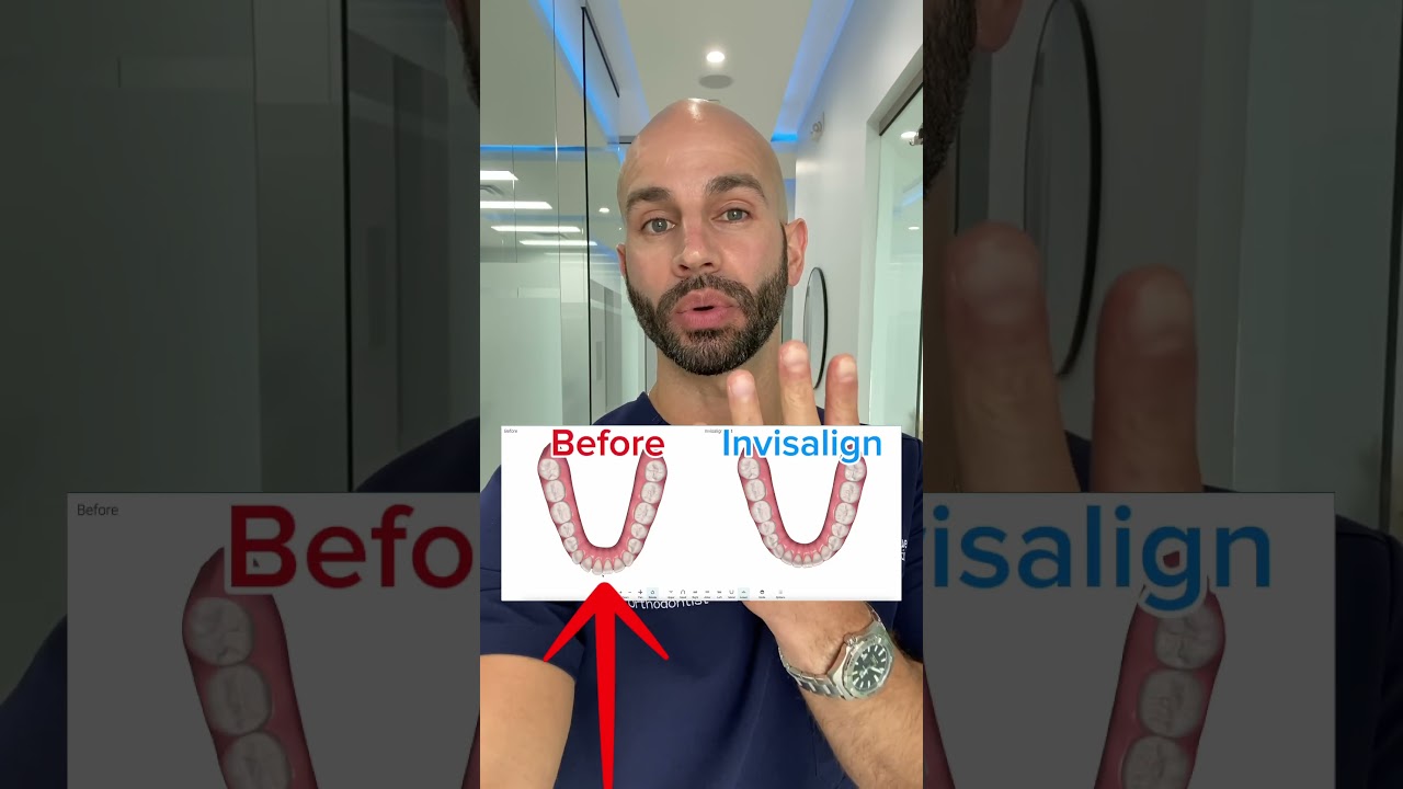 Invisalign for Underbite (2024)