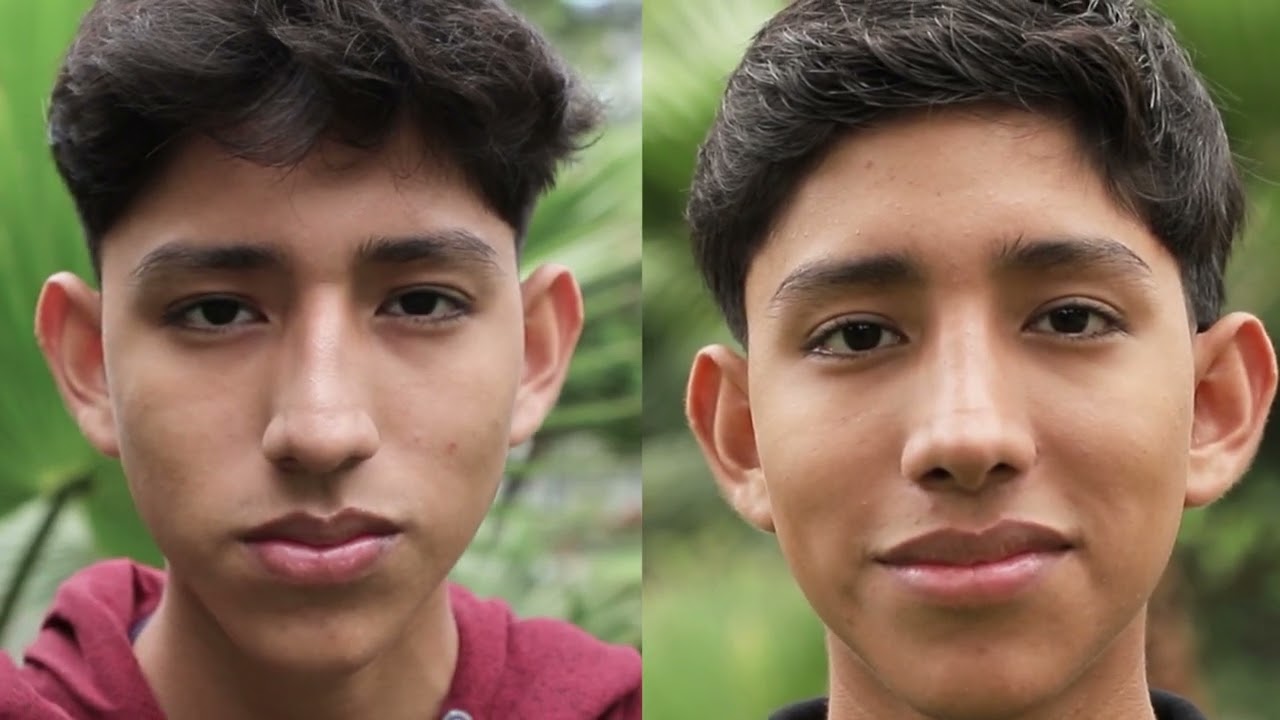 Rinoplastia en Lima | Dr. Iván Guanilo | Rinoplastia en hombres (caso completo)