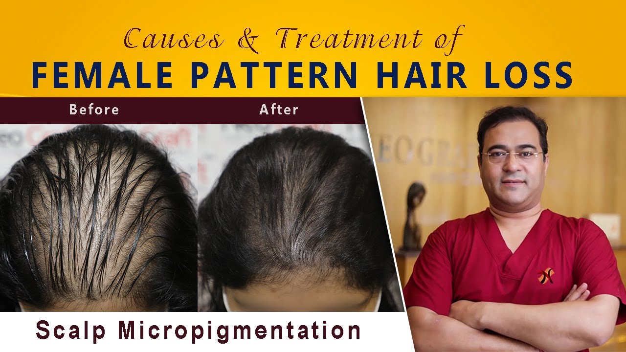 Female Pattern Hair Loss | Causes & Treatment (in 10 minutes)