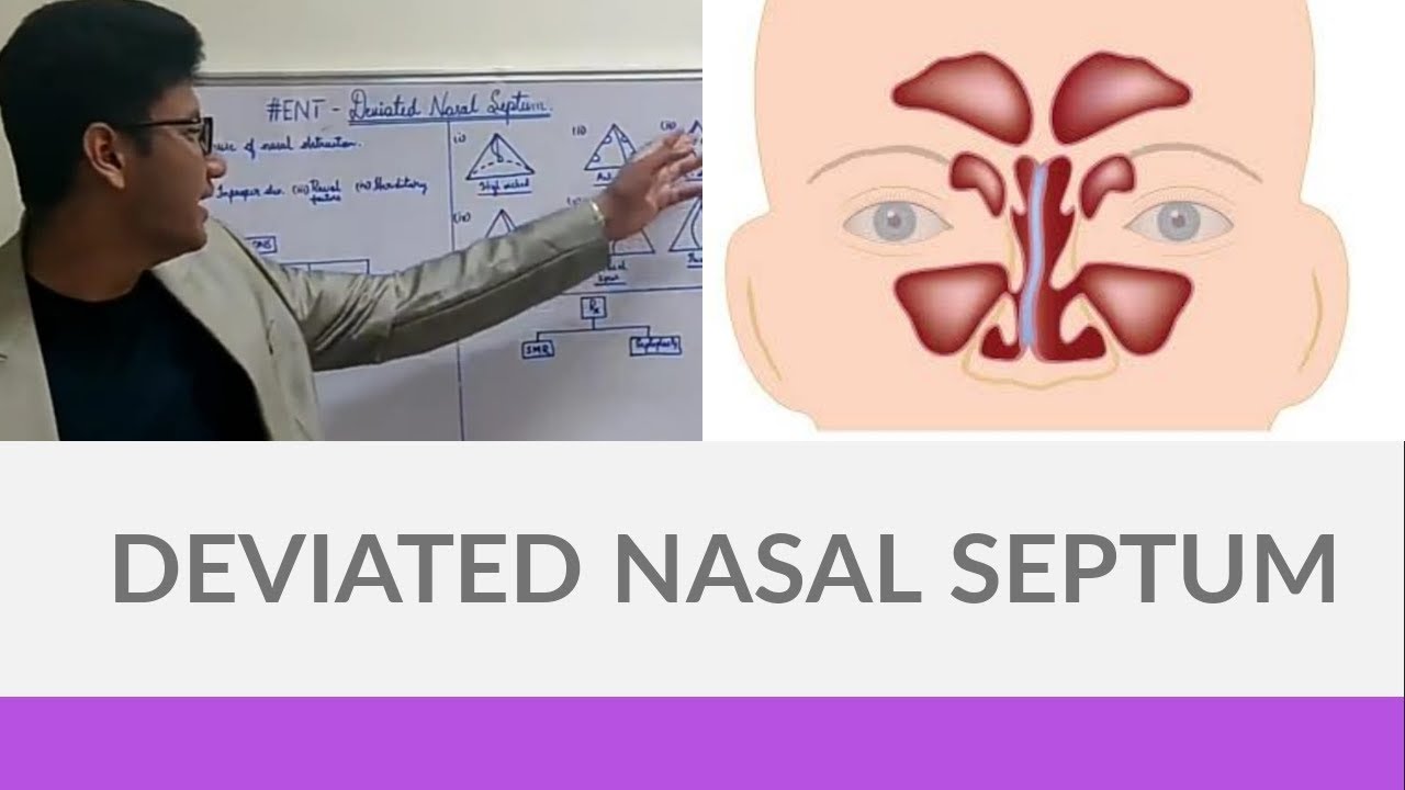 DEVIATED NASAL SEPTUM | The White Army