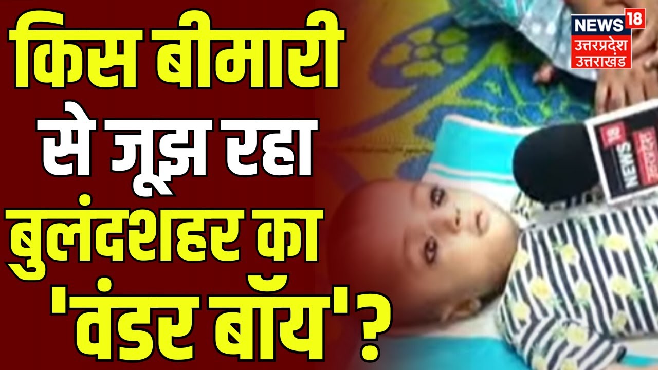 Bulandshahr News: किस बीमारी से जूझ रहा बुलंदशहर का 'वंडर बॉय'? | Tez Dimaag Duggu | Top News