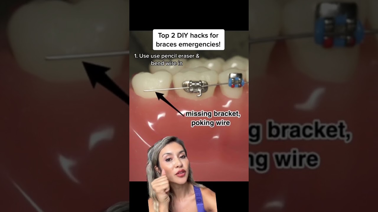 Top 2 Tips to Fix Poky Wires on Braces at Home