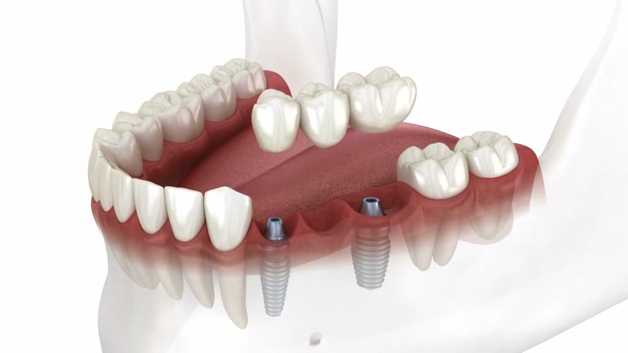 Hammasimplanttien asennus