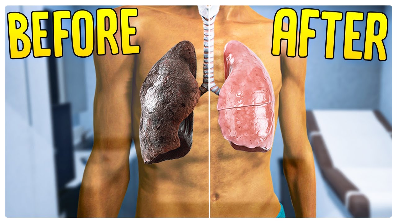 I'm Rich, So I Bought a Lung Transplant - Denizen