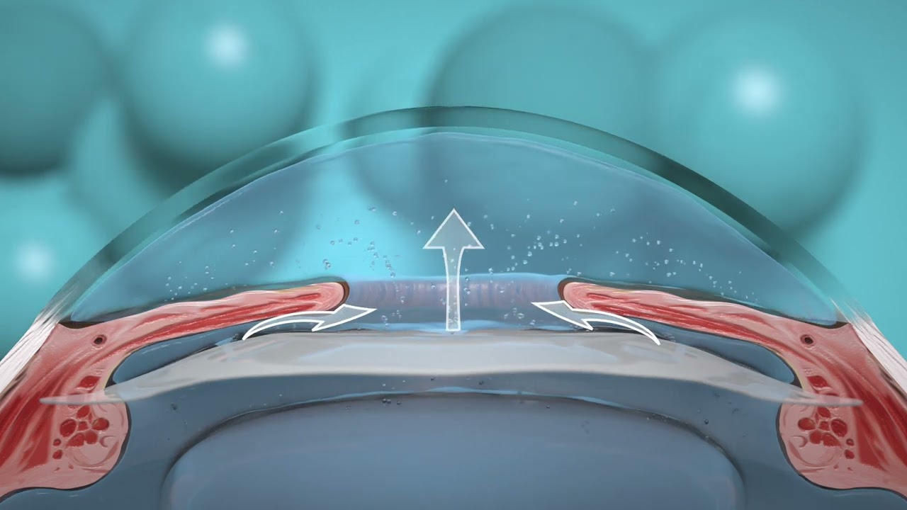 Staar ICL EVO Aqueous flow