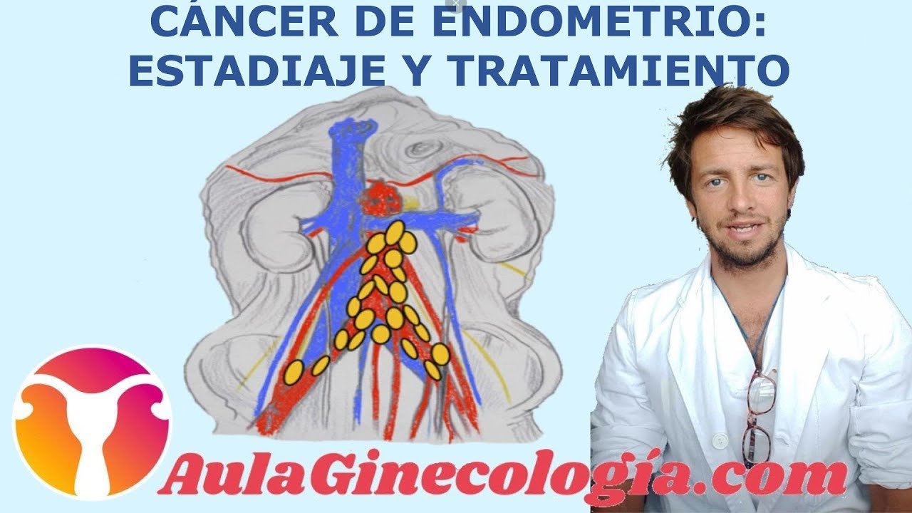 TRATAMIENTO y ESTADIAJE del CÁNCER de ENDOMETRIO: cirugía quimio y radio - Ginecología y Obstetricia