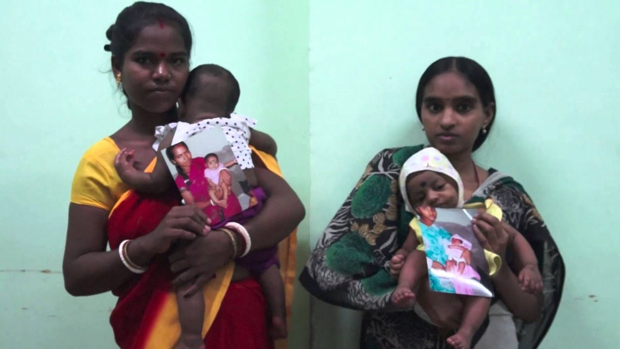 Treating Every Child with Clubfoot (Full Feature)