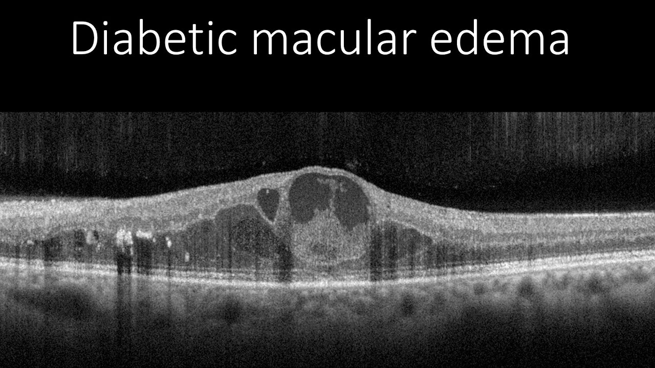 Course in clinical applications of OCT for macular diseases - Diabetic macular edema