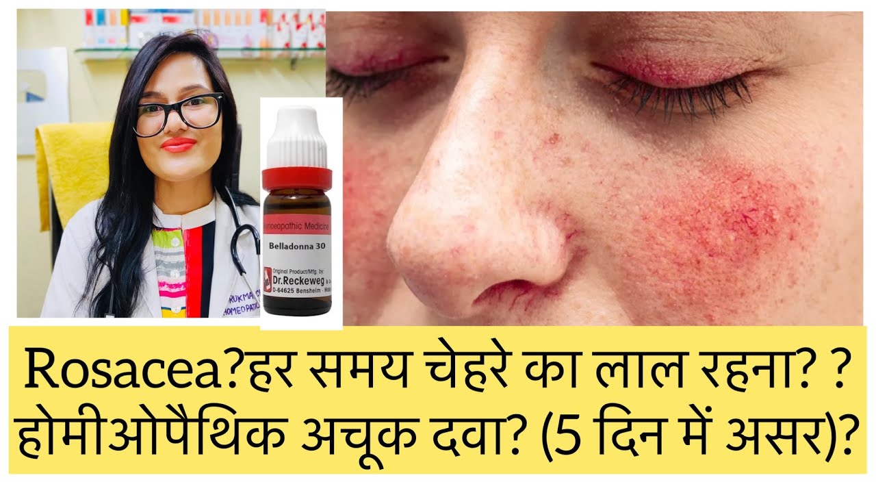 रोजेशा? चेहरे की ऐलर्जी? Rosacea Best Homeopathic Medicine? Acne Rosacea Homeopathic Treatment