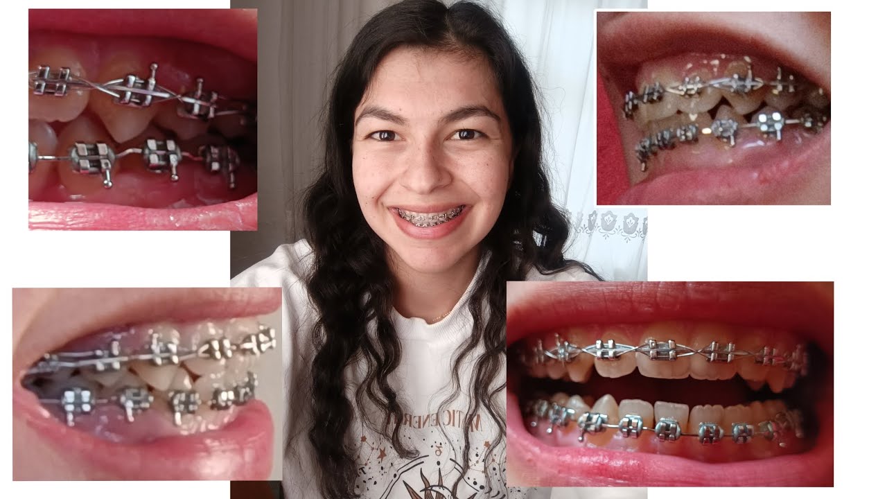 çekimli ortodontik tedavi sürecim-26 #dentist #dişteli #invisalign #orthodontist #ortodonti