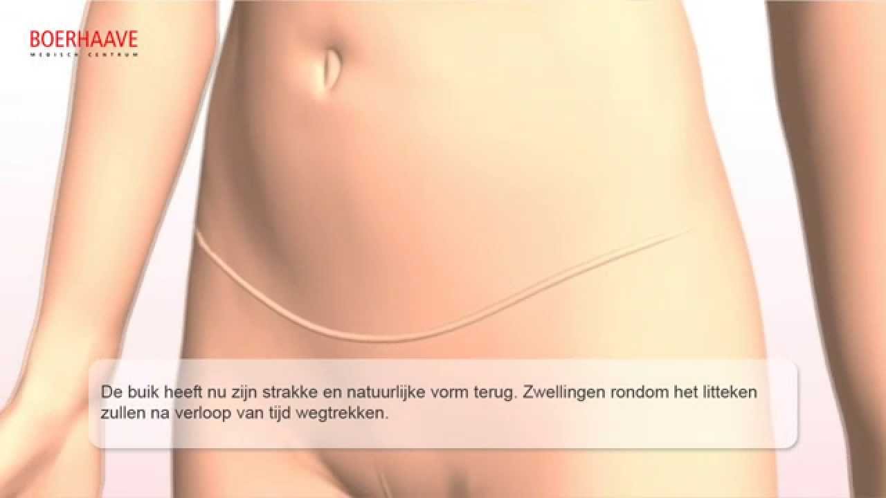 Buikwandcorrectie Animatie - Boerhaave Medisch Centrum