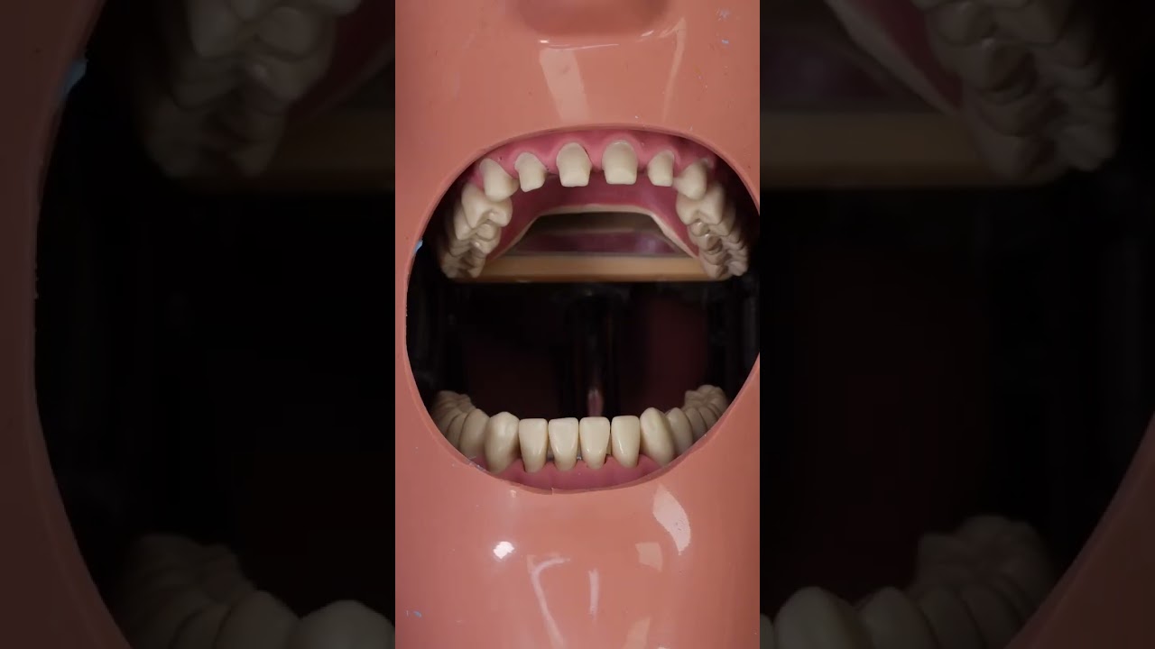Sectional Bite Method  - Full Arch Prep