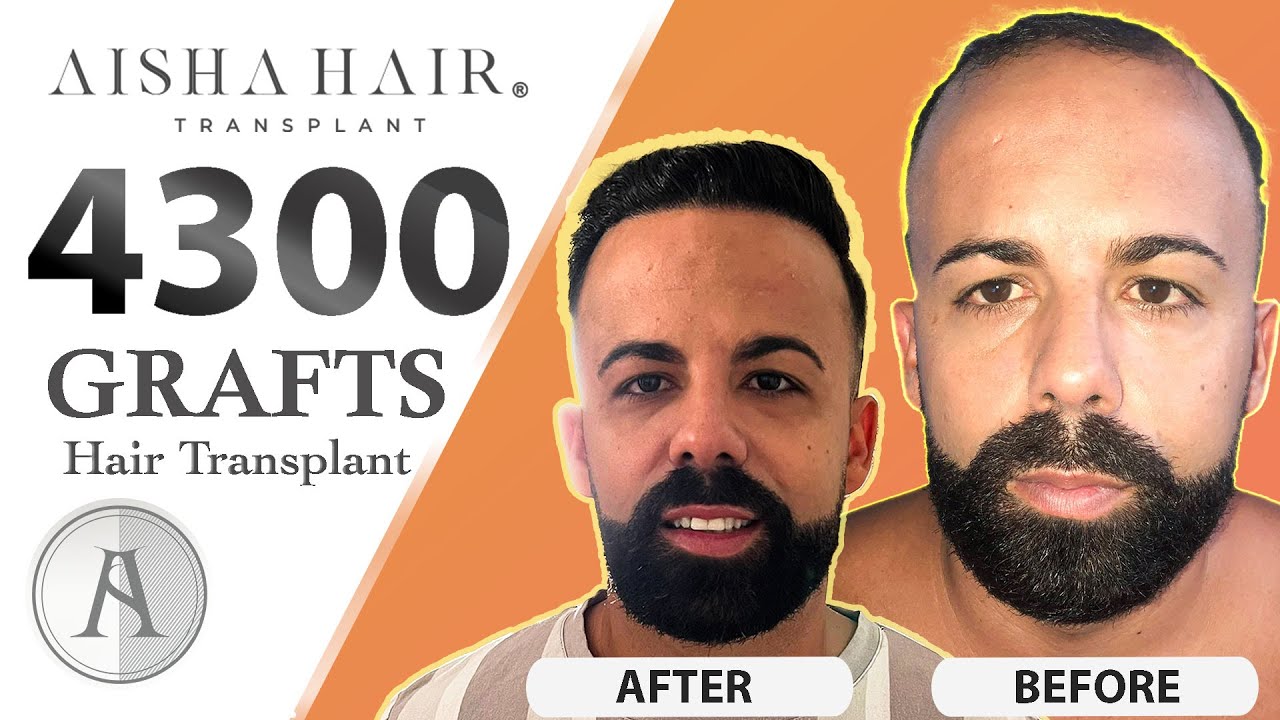 FUE Hair Transplant Result by Aisha Hair | Resultado Injerto Capilar Técnica FUE de Aisha Hair