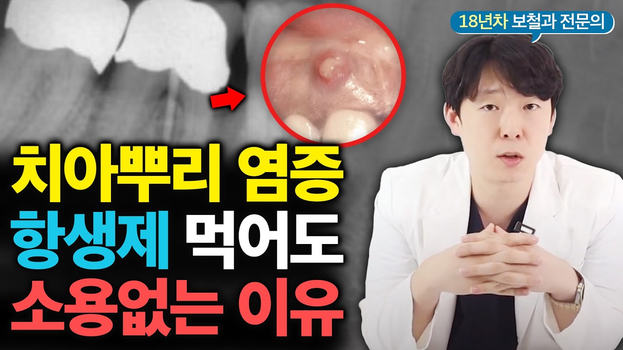 “생니 뽑고 임플란트 하래요…” 치아뿌리 염증, 솔직히 말씀드립니다