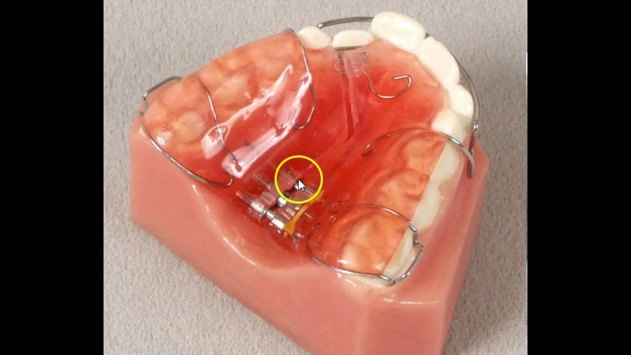 Unilateral X-Bite Expansion Appliance