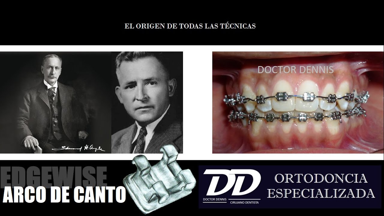 EDGEWISE (ARCO DE CANTO)