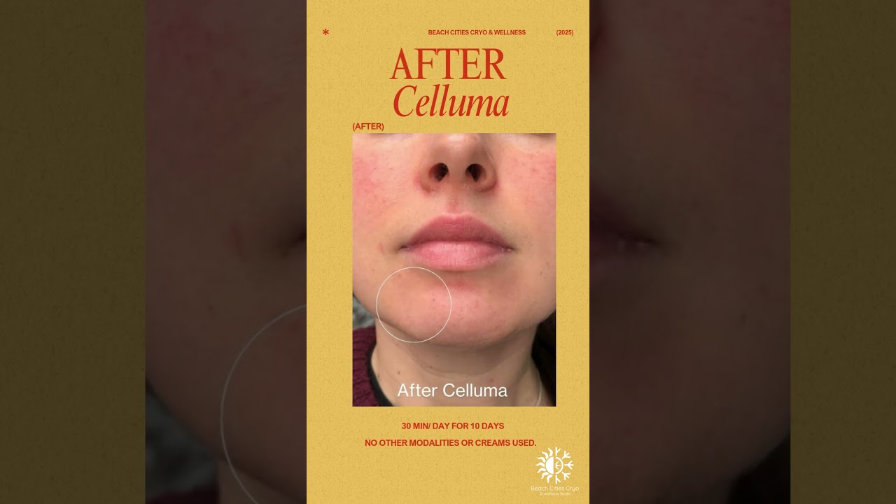 Celluma light therapy for anti aging #skincare #wellness #torrance #southbay  #celluma #redlight