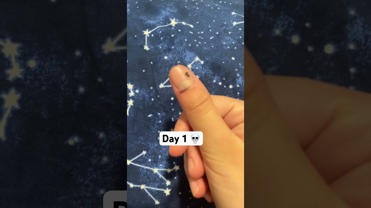 I slammed my finger in the car door 💀 update tomorrow