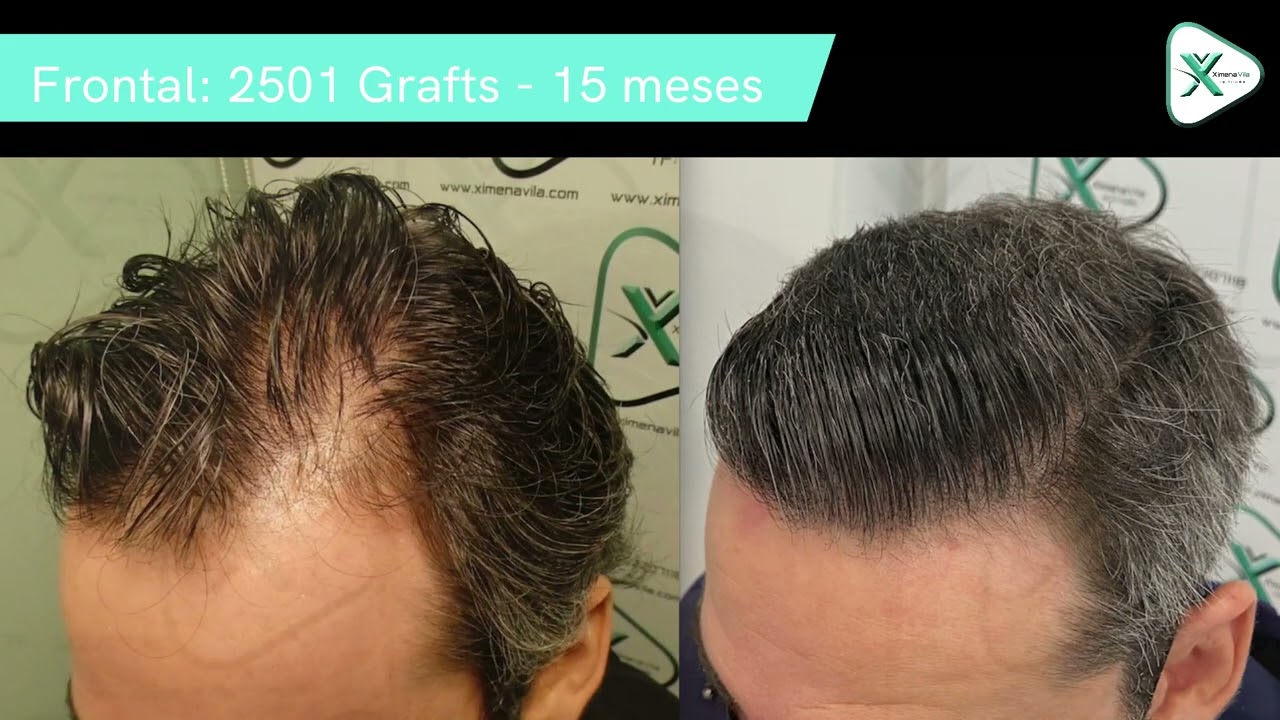 Trasplante Capilar FUE - Hair Transplant - Dra. Ximena Vila - 2.501 Grafts