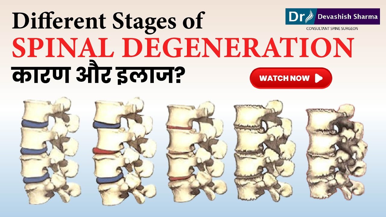 Different Stages of Spinal Degeneration | Degenerative Disc Disease Treatment In India -Dr Devashish