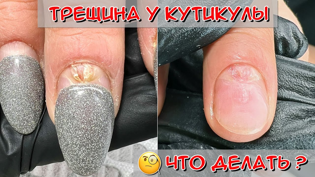 Трещина у кутикулы / Онихорексис - трещина на ногте