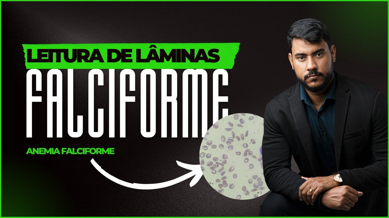 Leitura de lâminas - Anemia Falciforme