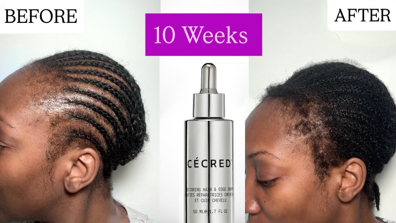 Cécred Restoring Hair & Edge Drops Review   Before & After 10 Weeks