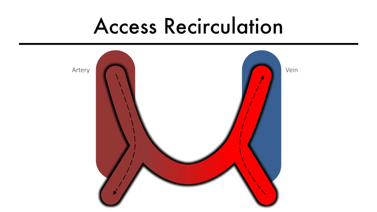 Hemodialysis Kinetics 101 08 Access Recirculation