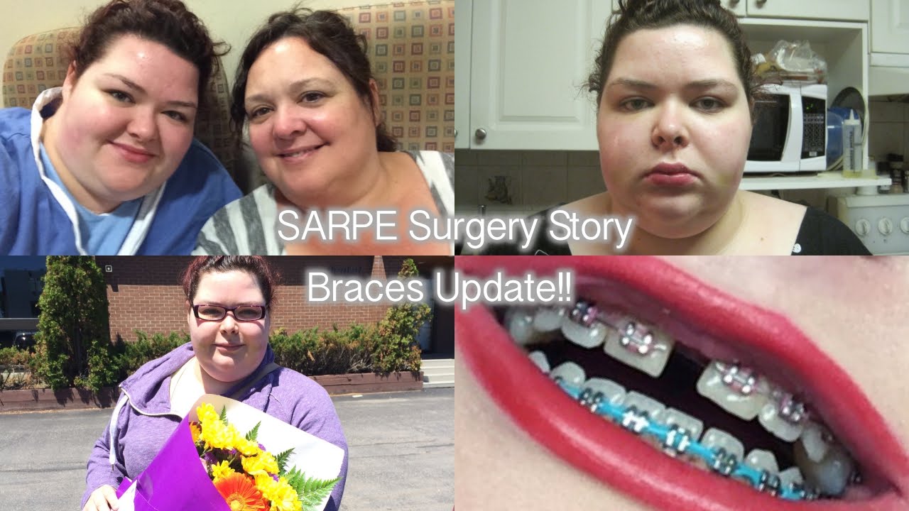 My Braces Story - Episode 2 ♡ SARPE SURGERY