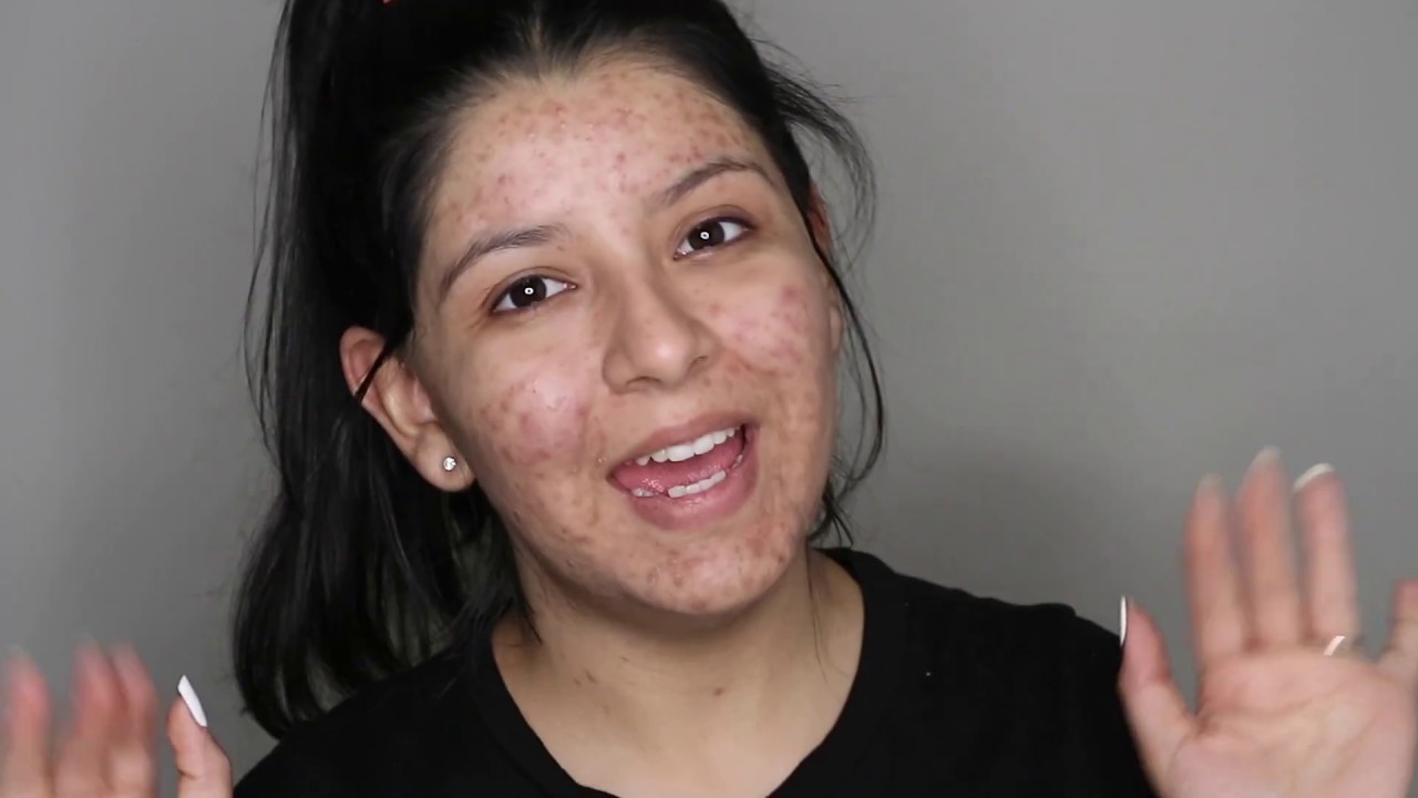 Dermablend Full Coverage Foundation for Cystic Acne