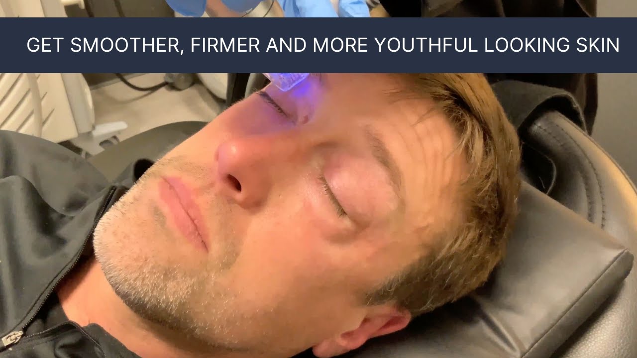 Treat Fine Lines and Wrinkles Around the Eyes with RF Microneedling