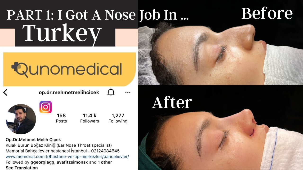 I GOT A NOSE JOB IN TURKEY - ISTANBUL PART 1 - QUNOMEDICAL | op dr mehmet melih çiçek