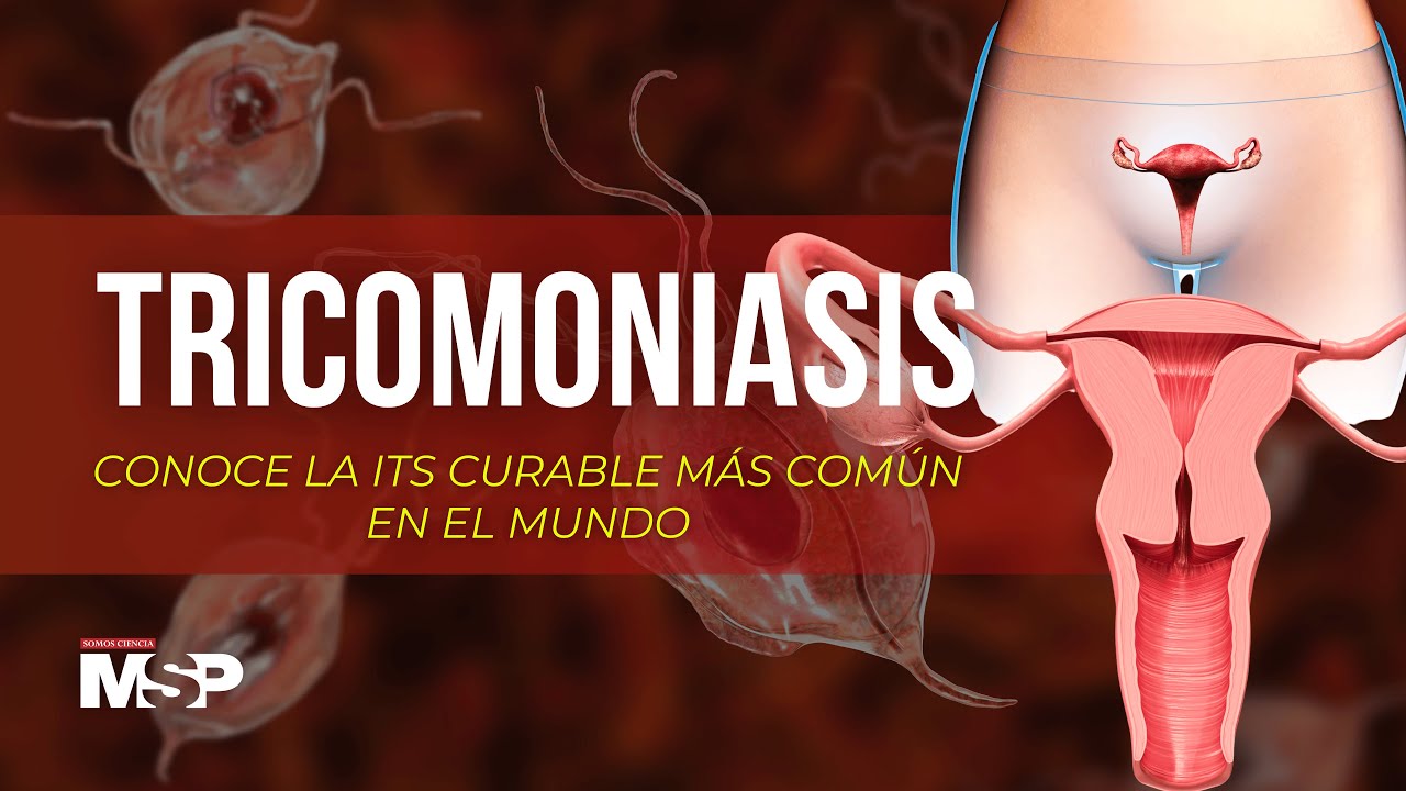 ¿QUÉ ES LA TRICOMONIASIS? 🦠 | GUÍA COMPLETA SOBRE CAUSAS, PREVENCIÓN Y MANEJO CLÍNICO | MSP