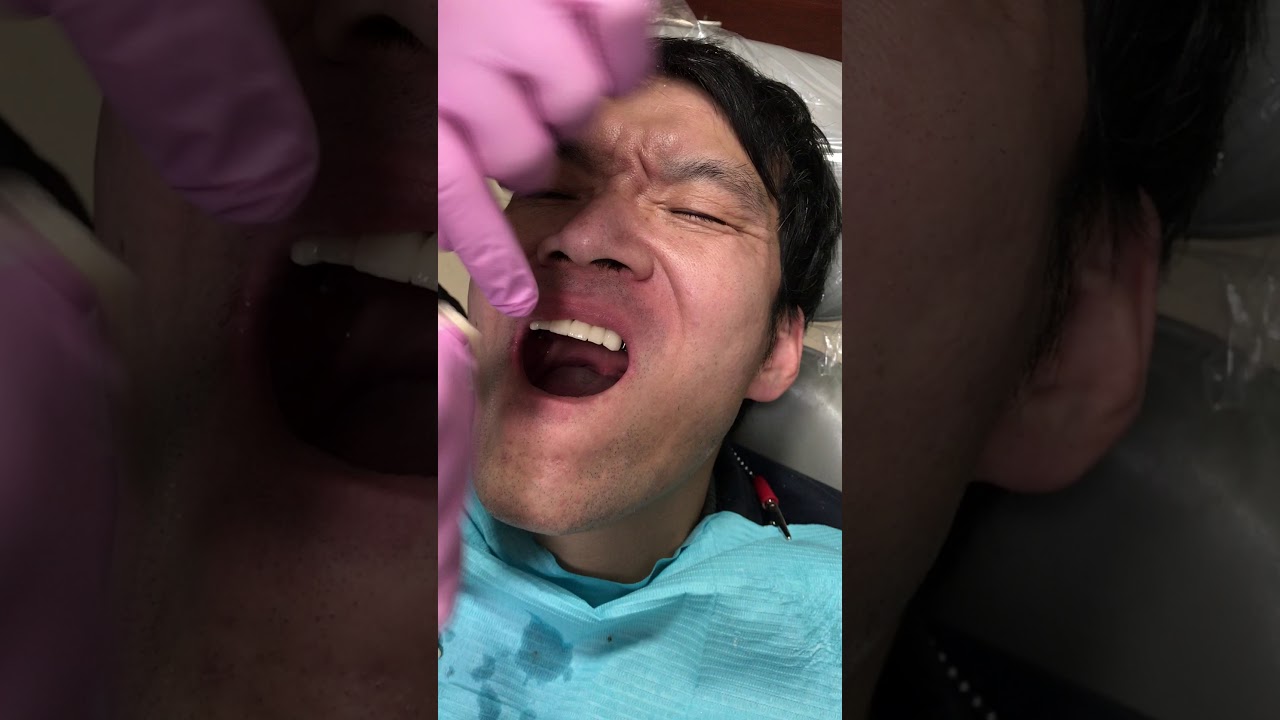 All on 8 Dental Implant Video 2