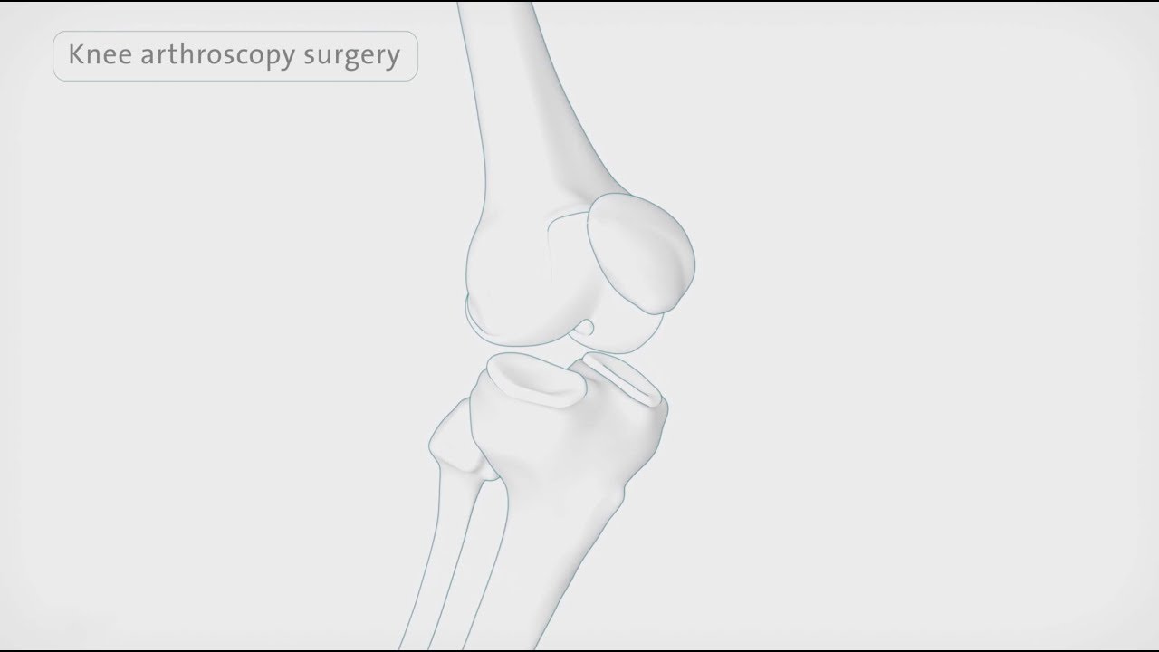 Jak wykonuje się artroskopię kolana | Spire Healthcare