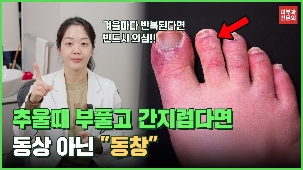 초겨울 피부가 부풀고 간지럽다면? 동상이 아닌 동창입니다