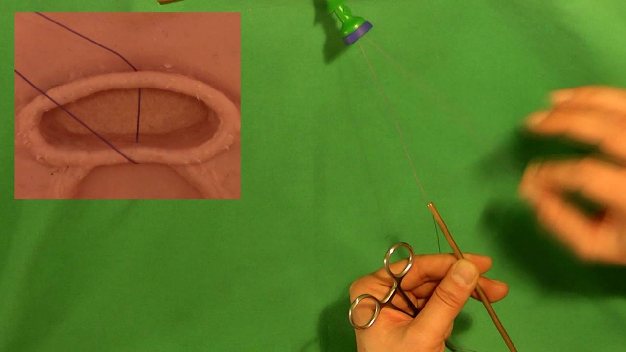 Laparoscopic Extracorporeal Knot Tying