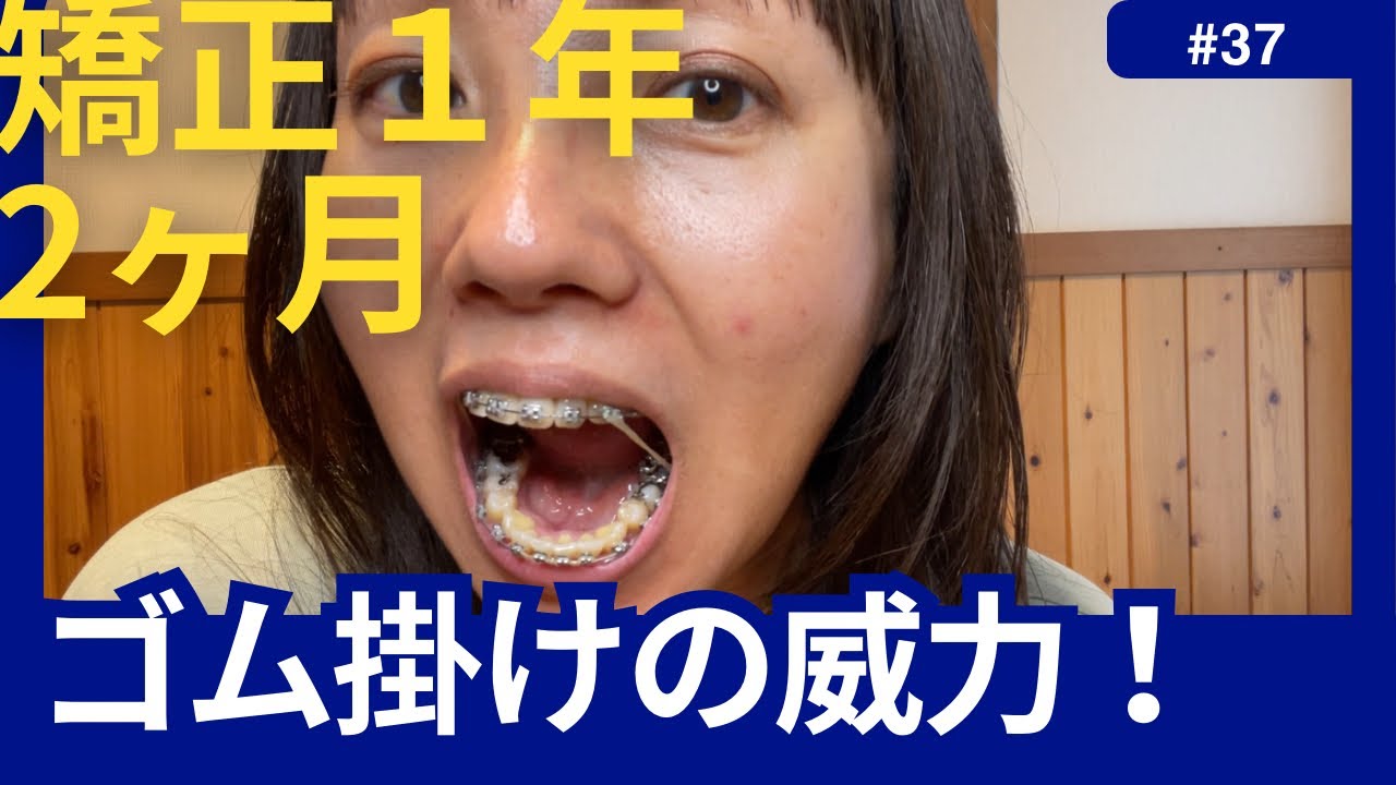 【歯列矯正日記#37】矯正1年2ヶ月！ゴム掛けの威力に感動！