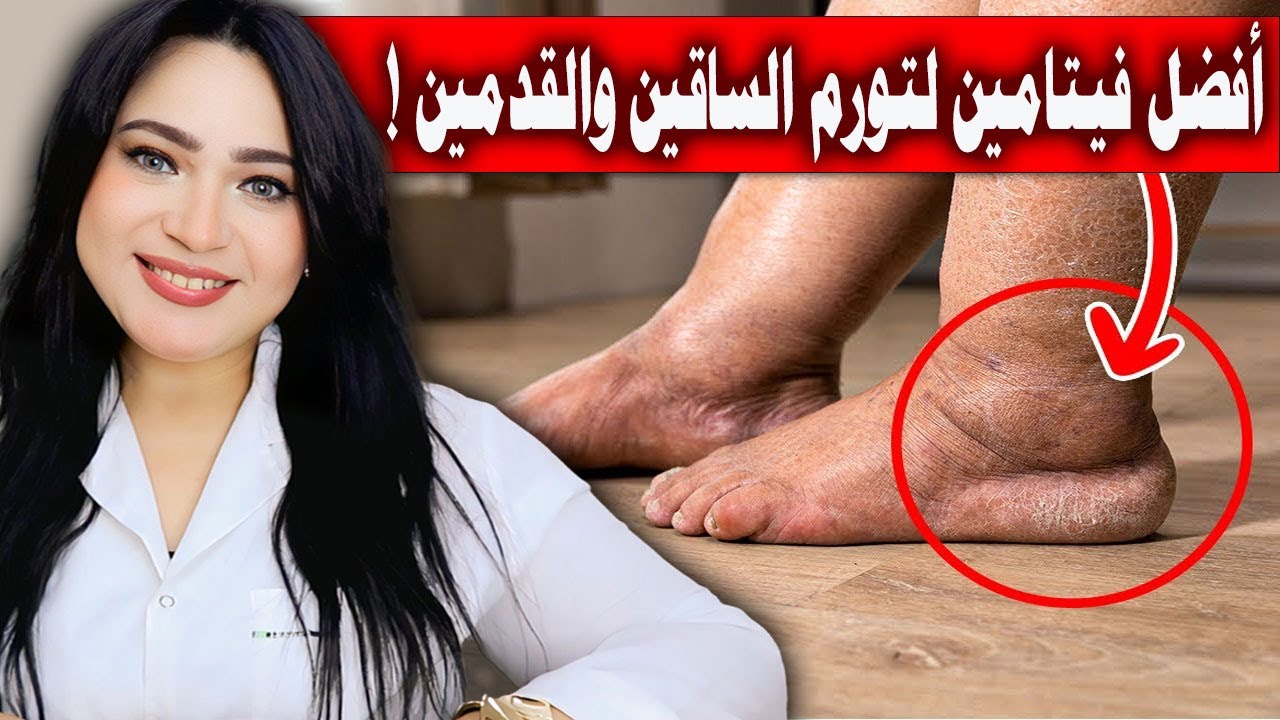 أفضل فيتامين لعلاج تورم القدم والساقين والكاحلين والتخلص من انتفاخ الرجلين مهما كان عمرك !