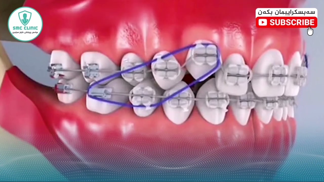 ♦ ڕێککردنەوەی دان بە تەلی دان