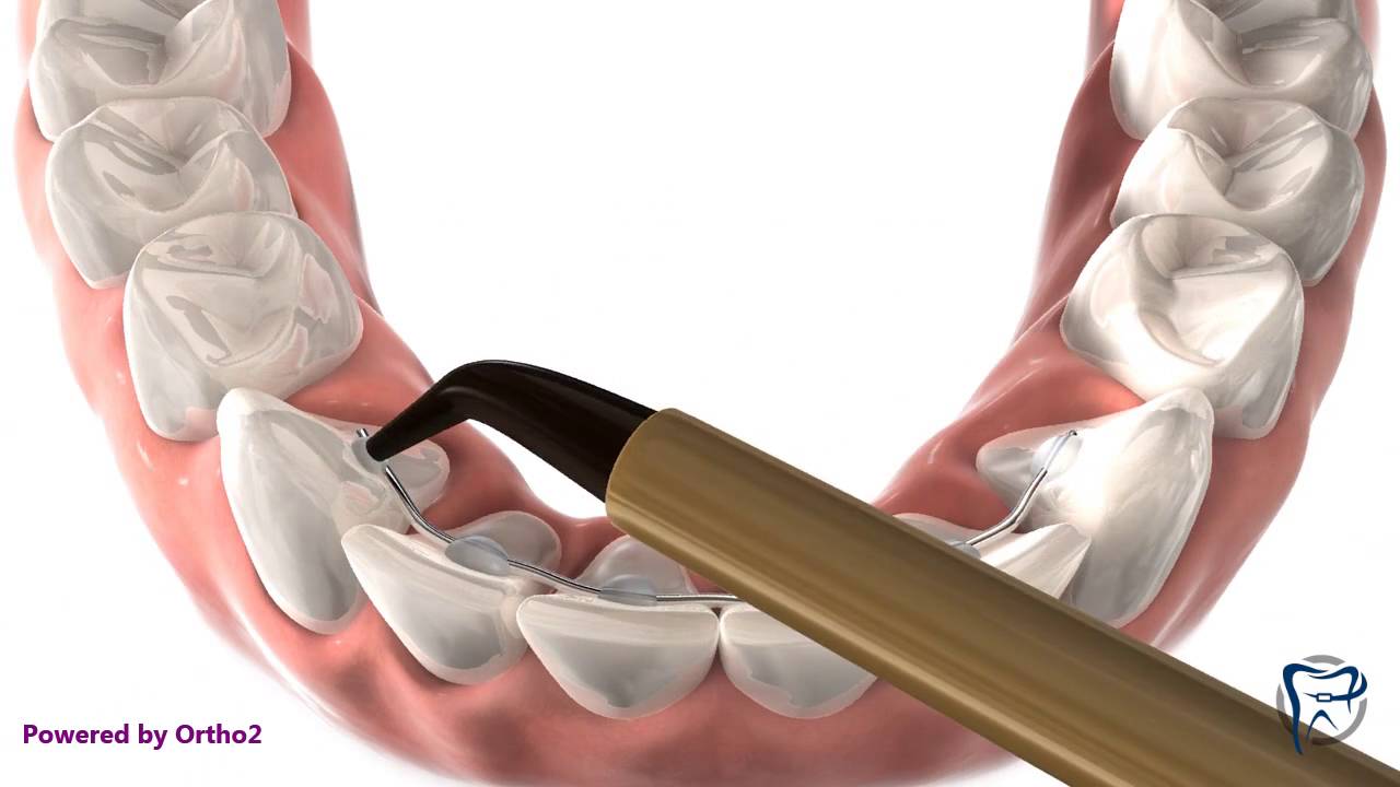 Bonded Retainer