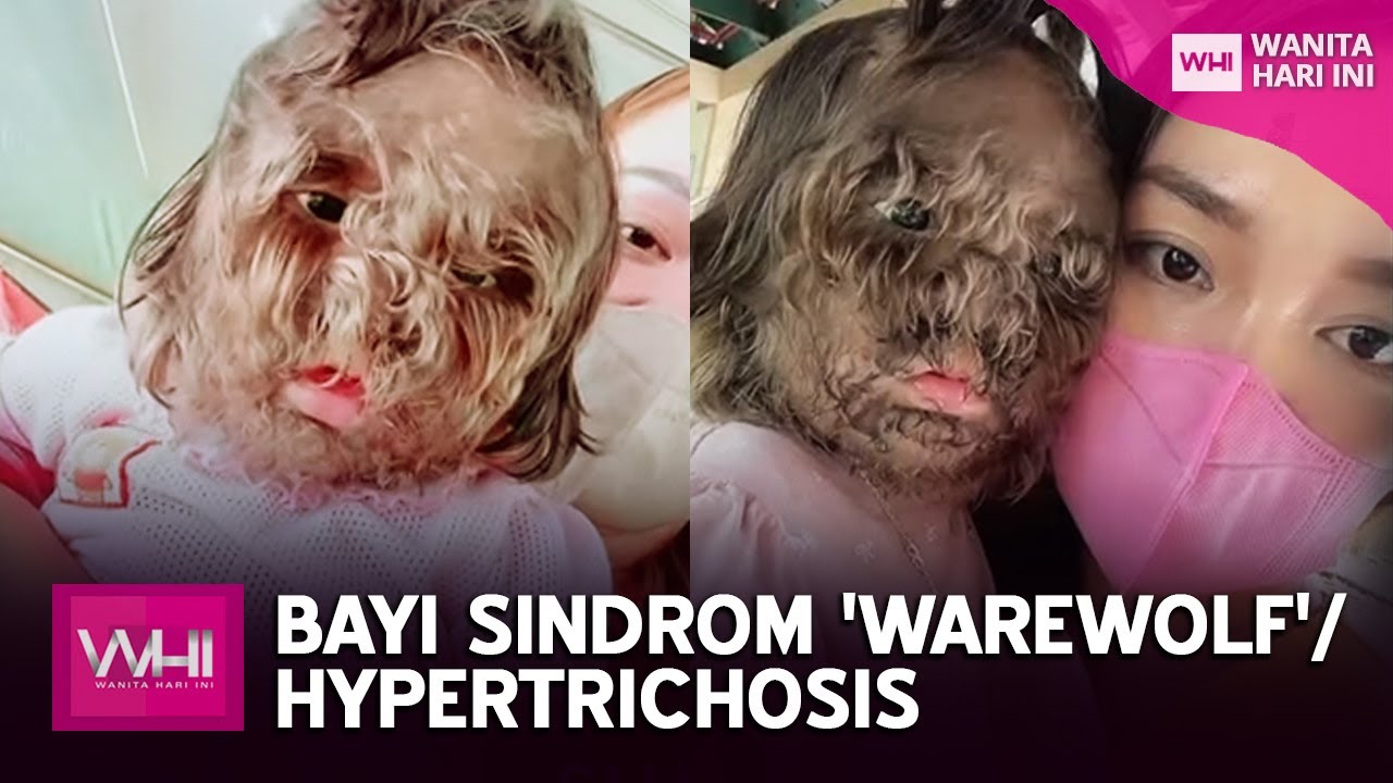 Bayi Sindrom 'Warewolf'/ Hypertrichosis | WHI (3 Ogos 2022)